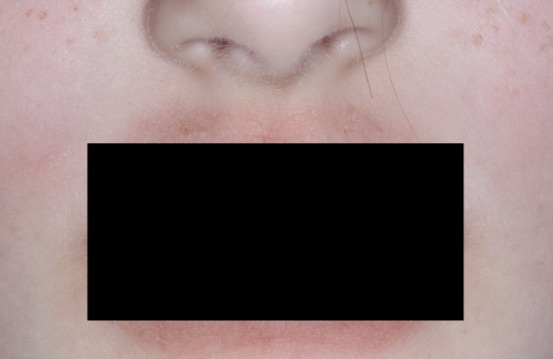 Mouth showing baseline vIGA-AD = 3, use the yellow slider button to see the after-treatment photo