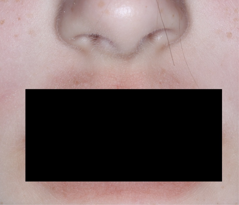 Face and mouth with atopic dermatitis before treatment - Baseline vIGA-AD = 3