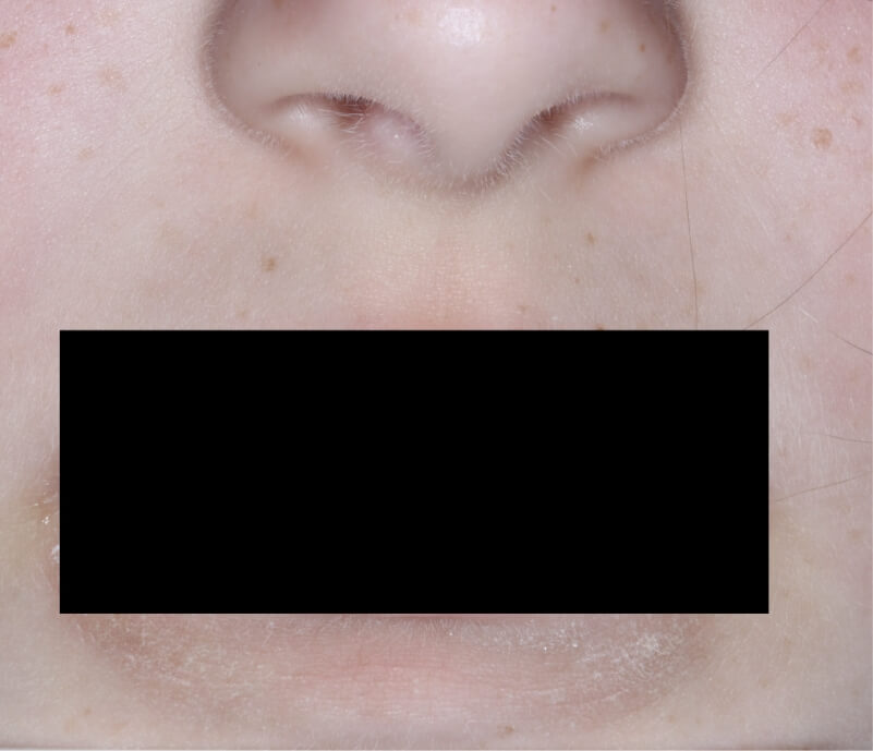 Face and mouth with atopic dermatitis on Week 1 of treatment - vIGA-AD = 1