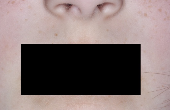 Mouth showing vIGA-AD = 0 after 4 weeks of treatment with ZORYVE, use the yellow slider button to see the before-treatment photo