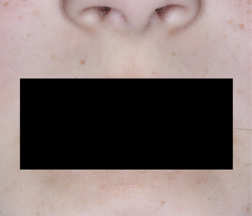 Face and mouth with atopic dermatitis on Week 4 of treatment - vIGA-AD = 0