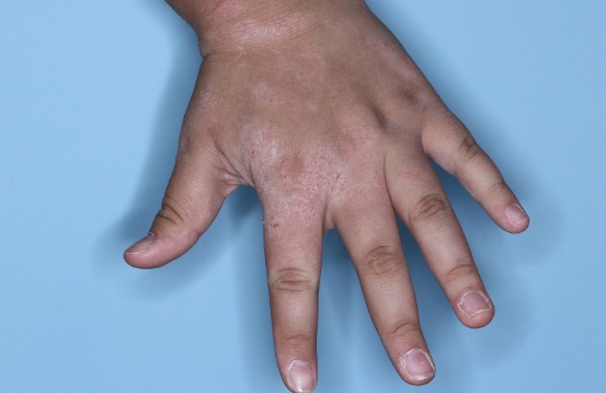 Hand showing baseline vIGA-AD = 3, use the yellow slider button to see the after-treatment photo