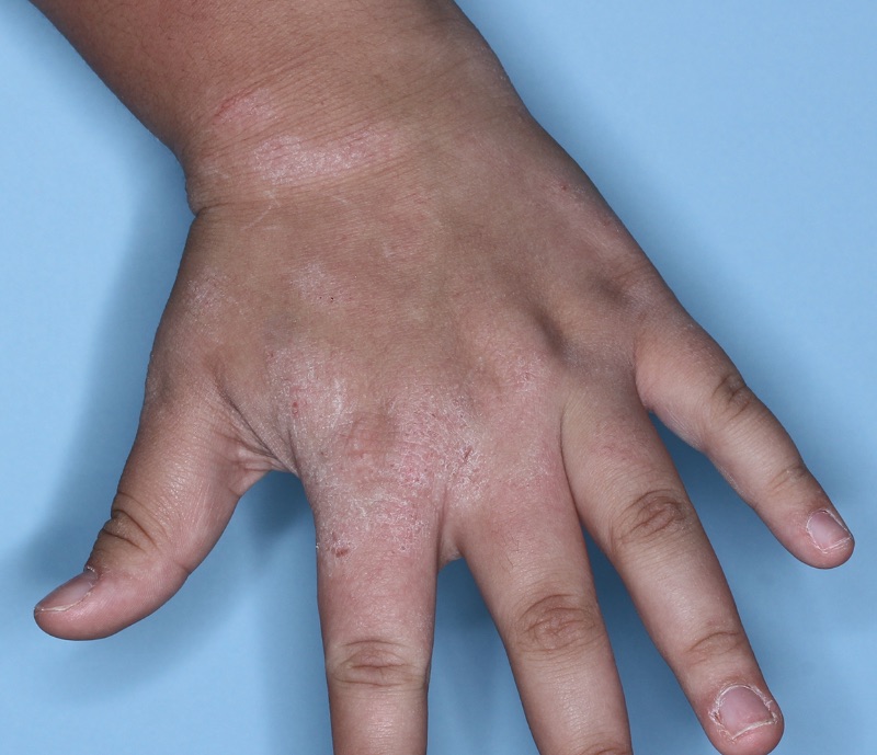 Hand with atopic dermatitis before treatment - Baseline vIGA-AD = 3