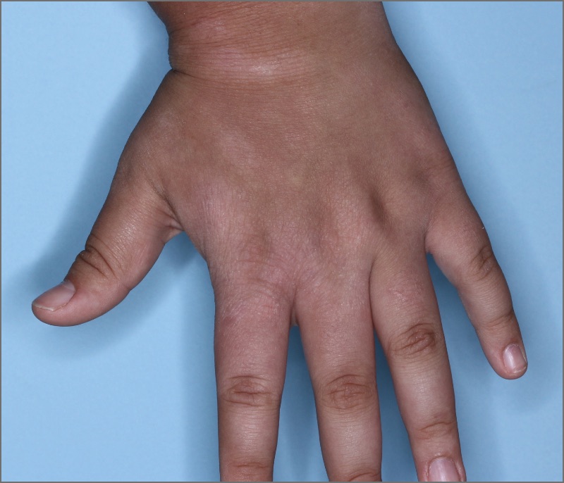 Hand with atopic dermatitis on Week 1 of treatment - vIGA-AD = 2