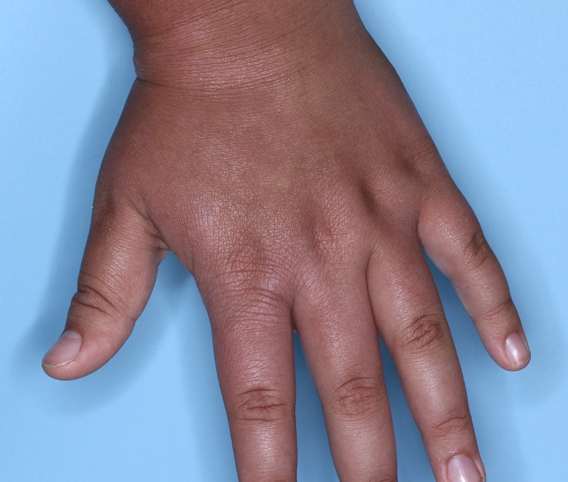 Hand with atopic dermatitis on Week 4 of treatment - vIGA-AD = 1