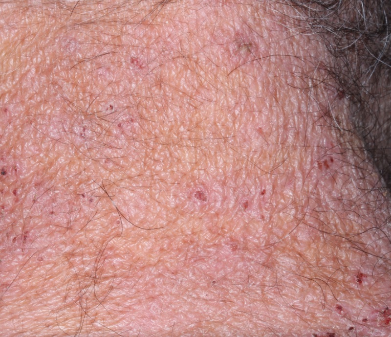 Neck with atopic dermatitis before treatment - Baseline vIGA-AD = 3