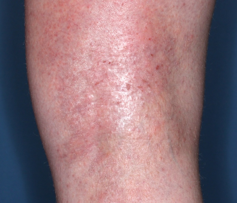 Popliteal Fossa with atopic dermatitis before treatment - Baseline vIGA-AD = 3