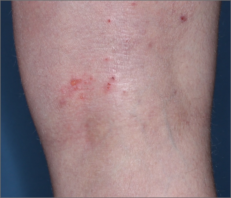 Popliteal Fossa with atopic dermatitis on Week 1 of treatment - vIGA-AD = 2