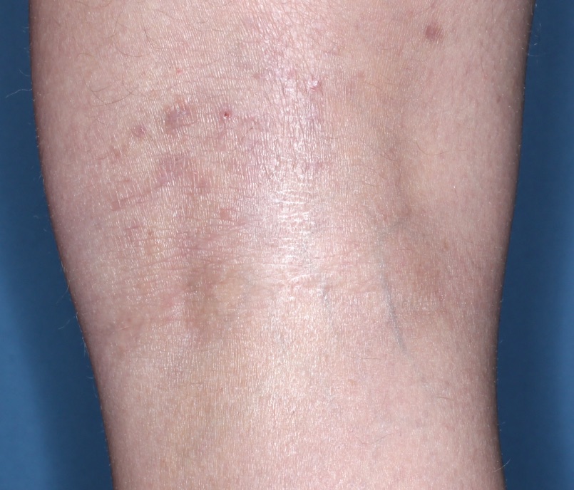 Popliteal Fossa with atopic dermatitis on Week 4 of treatment - vIGA-AD = 1