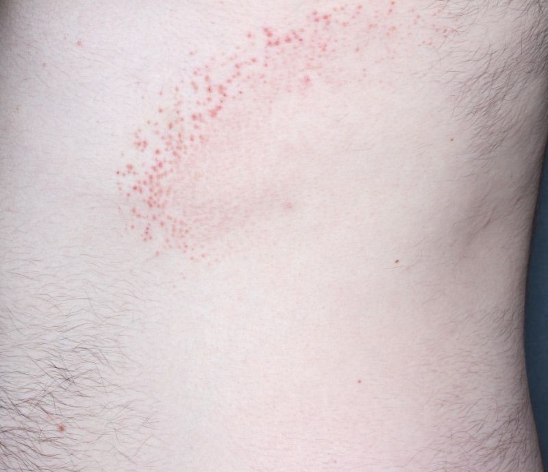 Trunk with atopic dermatitis before treatment - Baseline vIGA-AD = 3