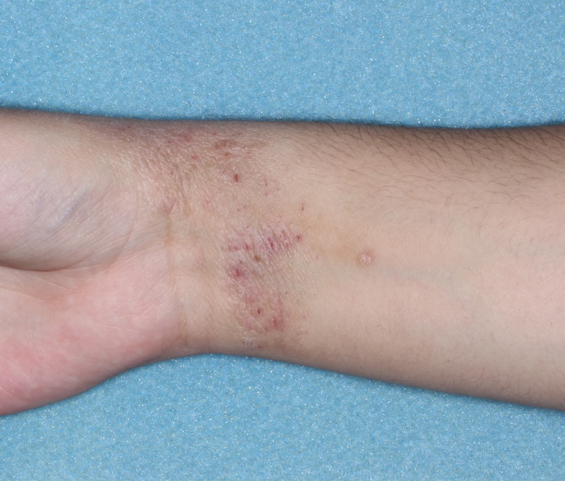 Wrist with atopic dermatitis before treatment - Baseline vIGA-AD = 3