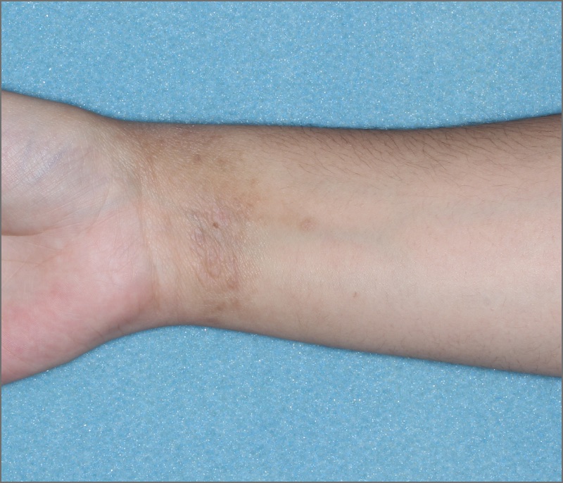 Wrist with atopic dermatitis on Week 1 of treatment - vIGA-AD = 2