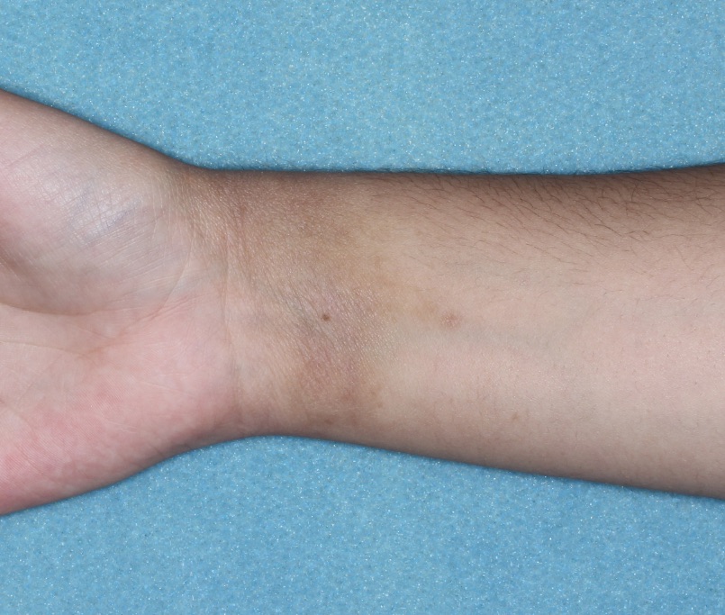 Wrist with atopic dermatitis on Week 4 of treatment - vIGA-AD = 0