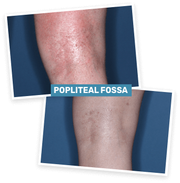 Baseline photo of a clinical trial patient’s popliteal fossa before treatment and Week 4 photo of a clinical trial patient’s popliteal fossa on ZORYVE