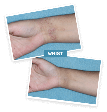 Baseline photo of a clinical trial patient’s wrist before treatment and Week 4 photo of a clinical trial patient’s wrist on ZORYVE